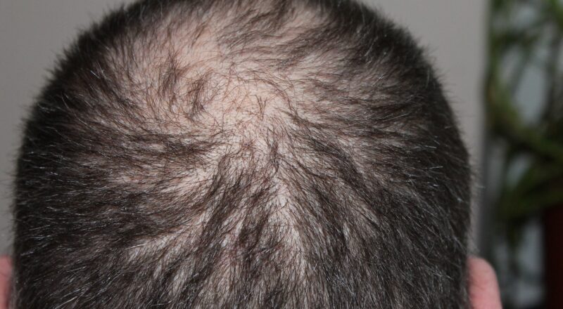 low-ferritin-and-hair-loss-here-is-what-you-should-know